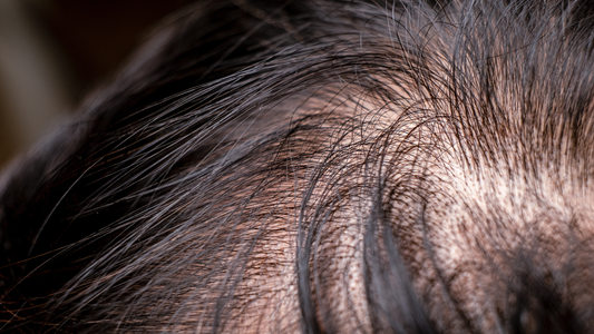 How Much Hair Loss Is Normal?