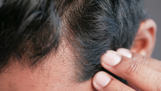 Natural DHT Blockers: How Nature Fights Hair Loss