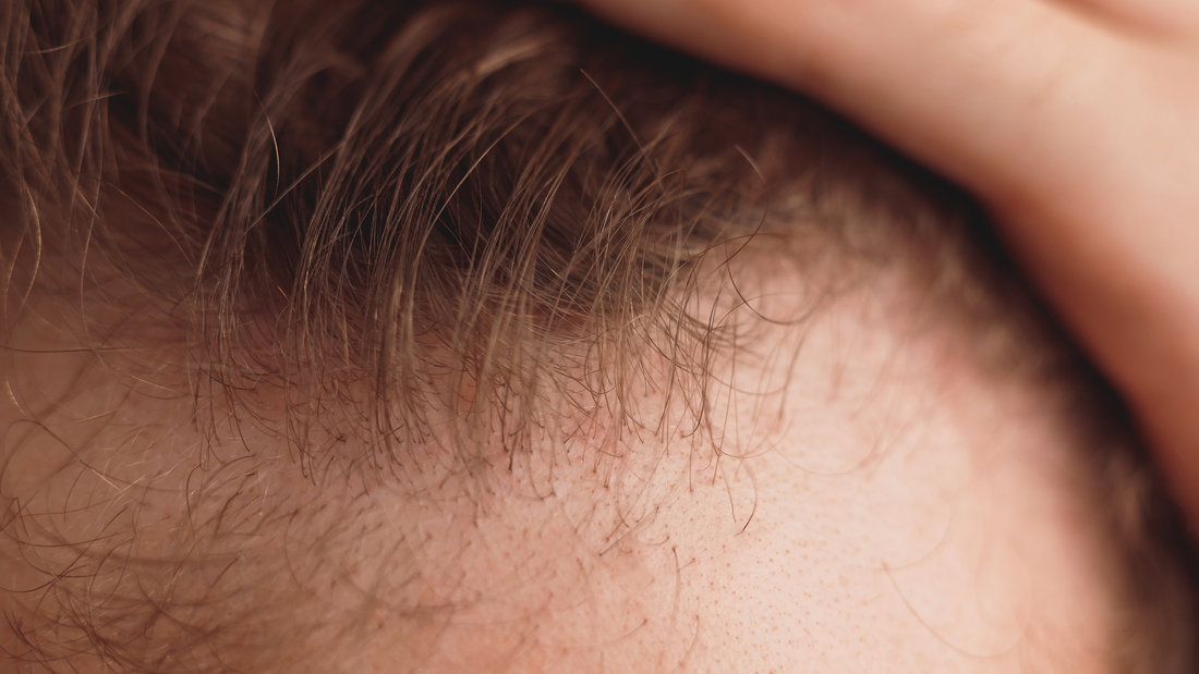 Weighing Your Hair Loss Treatment Options: Is A Hair Transplant Right For Me?